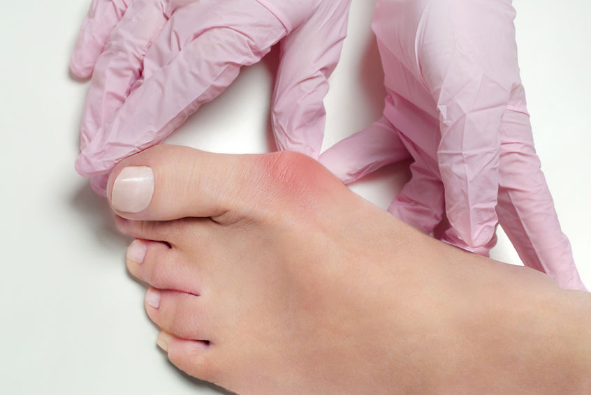 When to Consider Foot Callus Removal, Podiatrist located in Fort Worth, TX